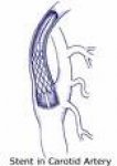 stent-u-začepljenju-karotidnih-arterija-hit-u-vaskularnoj-medicini