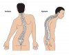 Schroth - deformiteti skolioza i kifoza schroth-deformiteti-skolioza-i-kifoza