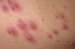 folikulitis