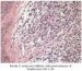 infiltratio-lymphocytaria-cutis