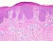 pseudolymphadenosis-actinica