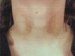 berloque-dermatitis