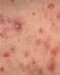 gestacijski-autoimuni-progesteronski-dermatitis