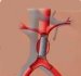 aortitis