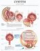 cistitis