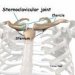 iščašenje-sternoklavikularnog-zgloba-luxatio-art-sternoclavicularis