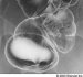 holecistoduodenalna-fistula