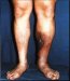 duboka-venska-tromboza-trombophlebitis-profunda