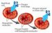 hemoglobinopatije