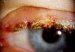 zapaljenje-rubova-kapaka-blepharitis