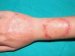 tinea-corporis