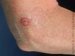 keratoacanthoma