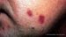 granuloma-pyogenicum