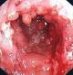 kronova-bolest-morbus-crohn