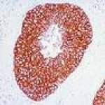 rak-jednjaka-karcinom-jednjaka