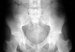 osteomalacija