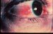 scleritis