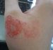 iritacioni-kontaktni-dermatitis