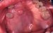 neurofibrom