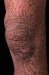 ichthyosis-vulgaris
