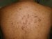 neurofibromatosis-generalisata