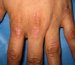 epidermolysis-bullosa-acquisita