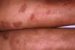 erythrokeratodermia-figurata-variabilis