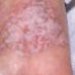 lichen-sclerosus-et-atrophicus