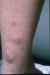 myxoedema-circumscriptum-symmetricum-praetibiale