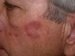 granuloma-faciale-eosinophilicum