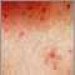 urticaria-pigmentosa