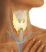 fibrozni-invazivni-tireoiditis