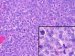 rak-prostate-karcinom-prostate