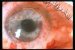 keratitis