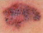 Tumor Koze