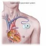 pacemaker.jpg