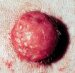 maligni-fibrozni-histiocitom