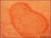 erythema-anulare-centrifugum