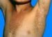 keratosis-follicularis