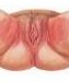 ulcus-vulvae-acutum