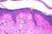 amyloidosis-cutis-maculos