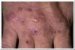 porphyria-cutanea-tarda