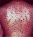 urticaria-pigmentosa-adultorum