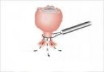 loop-dijatermija-loop-electrosurgical-excision-procedure-leep