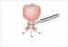 loop-dijatermija-loop-electrosurgical-excision-procedure-leep