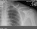 prelomi-ključne-kosti-fractura-claviculae