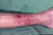 tromboflebitis-zapaljenje-površinskih-vena