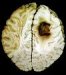 tumor-mozga
