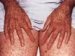 xeroderma-pigmentosum