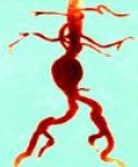 aneurizme-abdominalne-aorte-i-ilijačnih-arterija